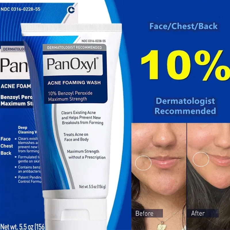PanOxyl Acne Foaming Wash Benzoyl Peroxide 10% Net Wt 5.5 Oz (156)