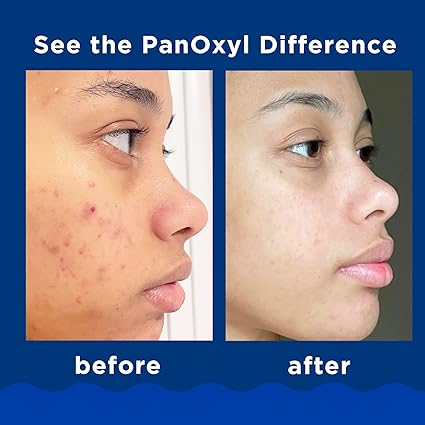 PanOxyl Acne Foaming Wash Benzoyl Peroxide 10% Net Wt 5.5 Oz (156)